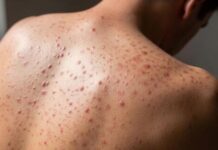 Confirman quinto caso de sarampión en Colombia